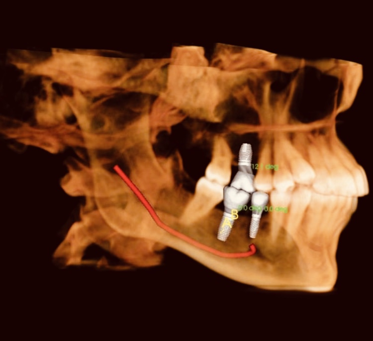 Implantology Surgical and Prosthetic Treatment